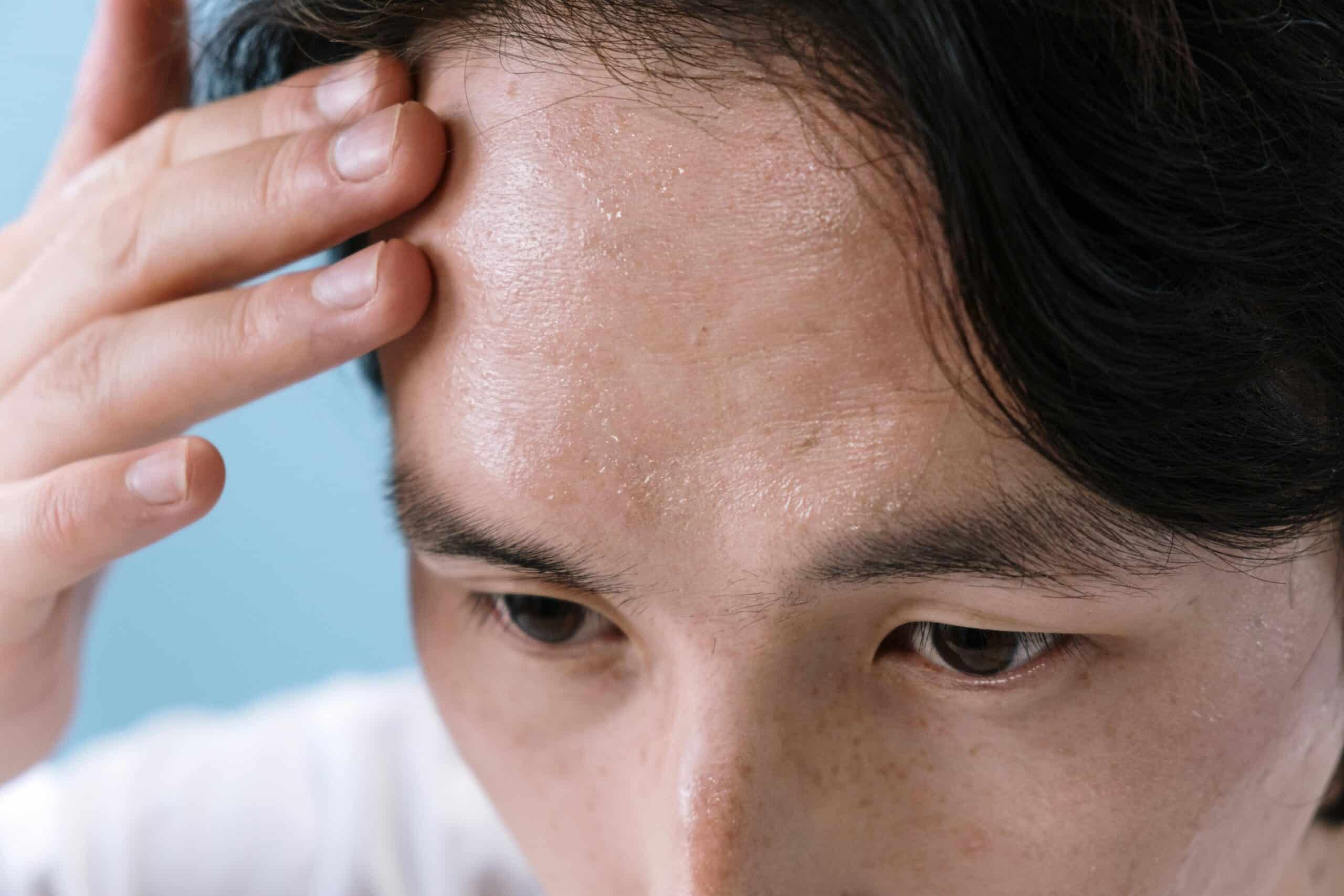 Descubra como se livrar imediatamente do suor excessivo nas mãos, axilas e pés! Adeus ao mau odor com 7 dicas poderosas!