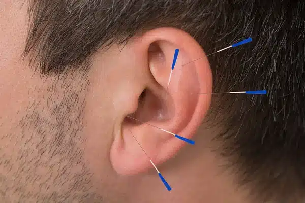 Estudo revela os benefícios da Acupuntura Auricular para diminuir os sintomas da depressão; Entenda
