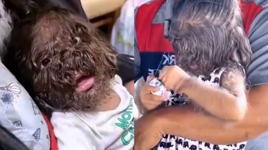 Descubra a Emocionante História da Criança que Desafia a Síndrome do Lobisomem!